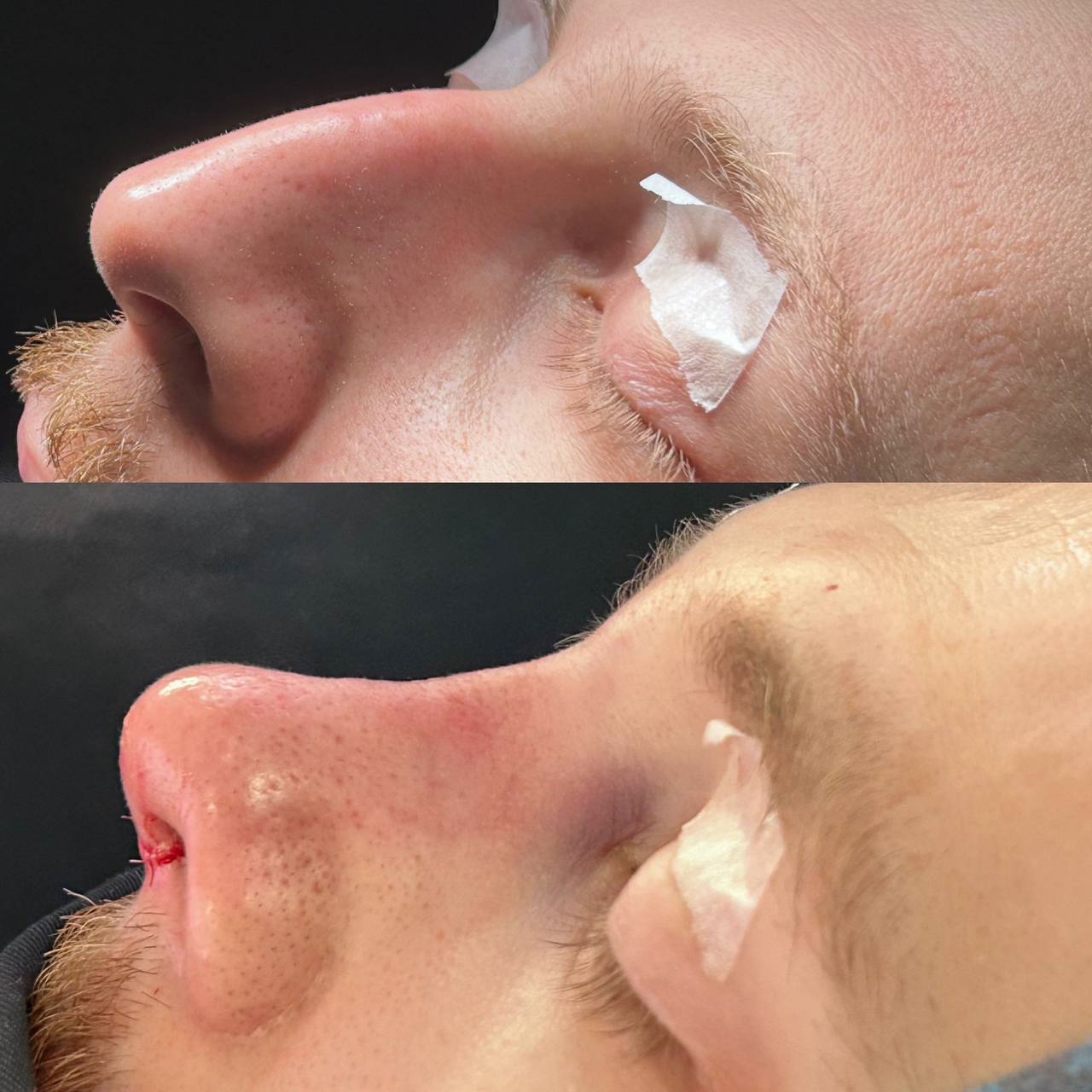 Ринопластика в Москве от лор-хирурга Егине Варосян